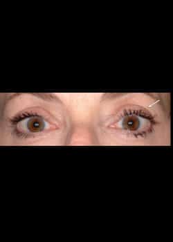 Eyelid Rejuvenation Case 14