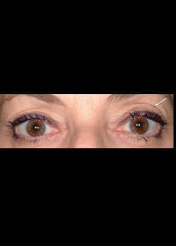 Eyelid Rejuvenation Case 14