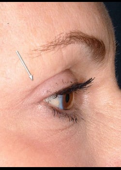 Eyelid Rejuvenation Case 15