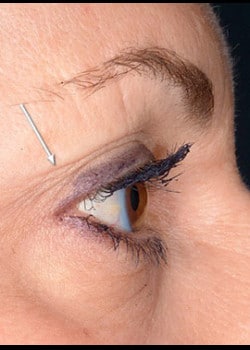 Eyelid Rejuvenation Case 15