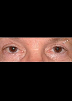 Eyelid Rejuvenation Case 16