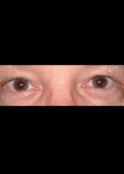 Eyelid Rejuvenation Case 16