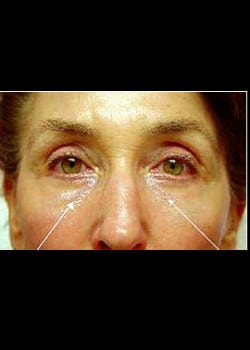 Eyelid Rejuvenation Case 17