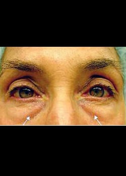 Eyelid Rejuvenation Case 17