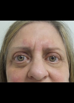 Eyelid Rejuvenation Case 19