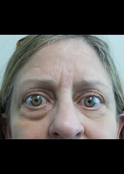 Eyelid Rejuvenation Case 19