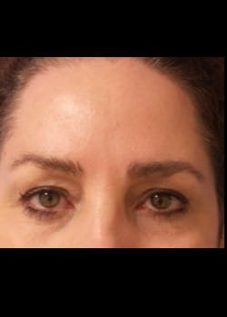 Eyelid Rejuvenation Case 20