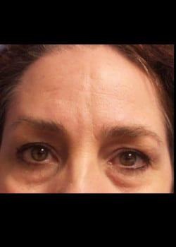 Eyelid Rejuvenation Case 20