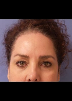 Eyelid Rejuvenation Case 21