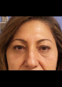 Eyelid Rejuvenation Case 22