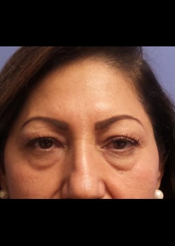 Eyelid Rejuvenation Case 22