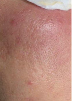 Microneedling Case 2