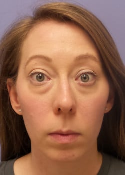 Eyelid Rejuvenation Case 27