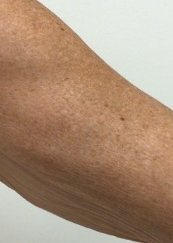 Hyperdilute Radiesse filler